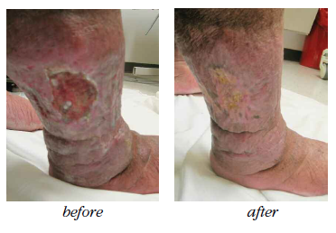 Lymphedema Care