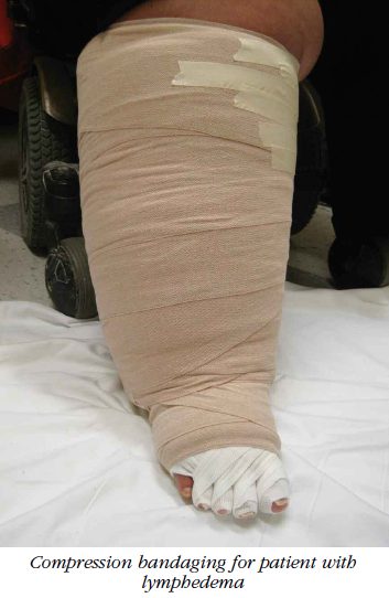 Lymphedema deals elastic bandage