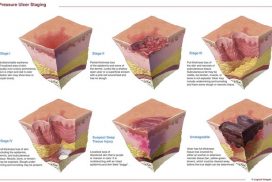 pressure ulcer staging