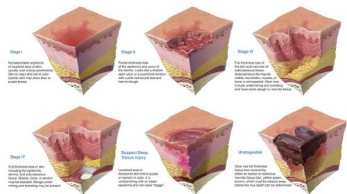 pressure ulcer staging