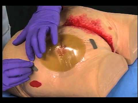 hydrocolloid dressing example1
