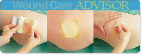 How to apply a hydrocolloid dressing