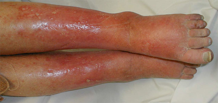 Reducing Cellulitis with Compression Therapy