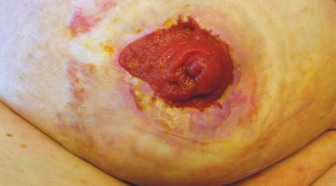 Understanding stoma complications - Wound Care Advisor