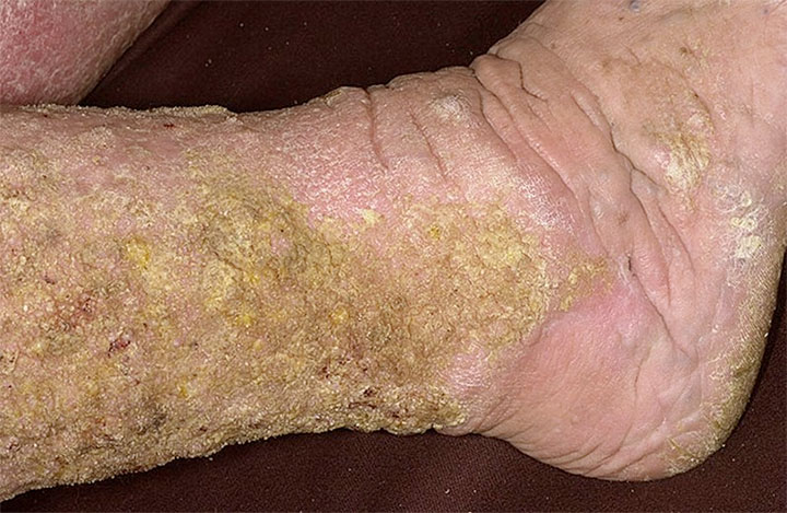 Venous dermatitis