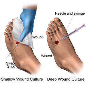 how to culture a chronic wound