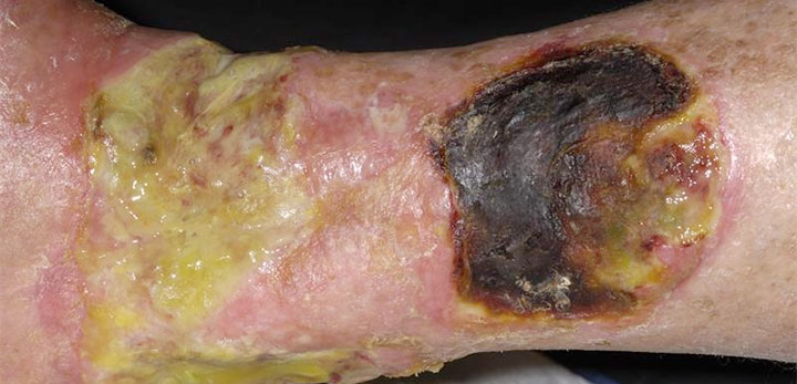 Serous Wound Drainage