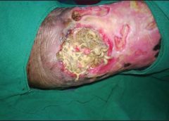 maggots in wound care