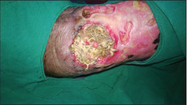 debridement maggots