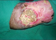 Maggots Wound Care