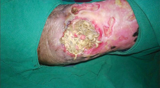 Maggots Wound Care