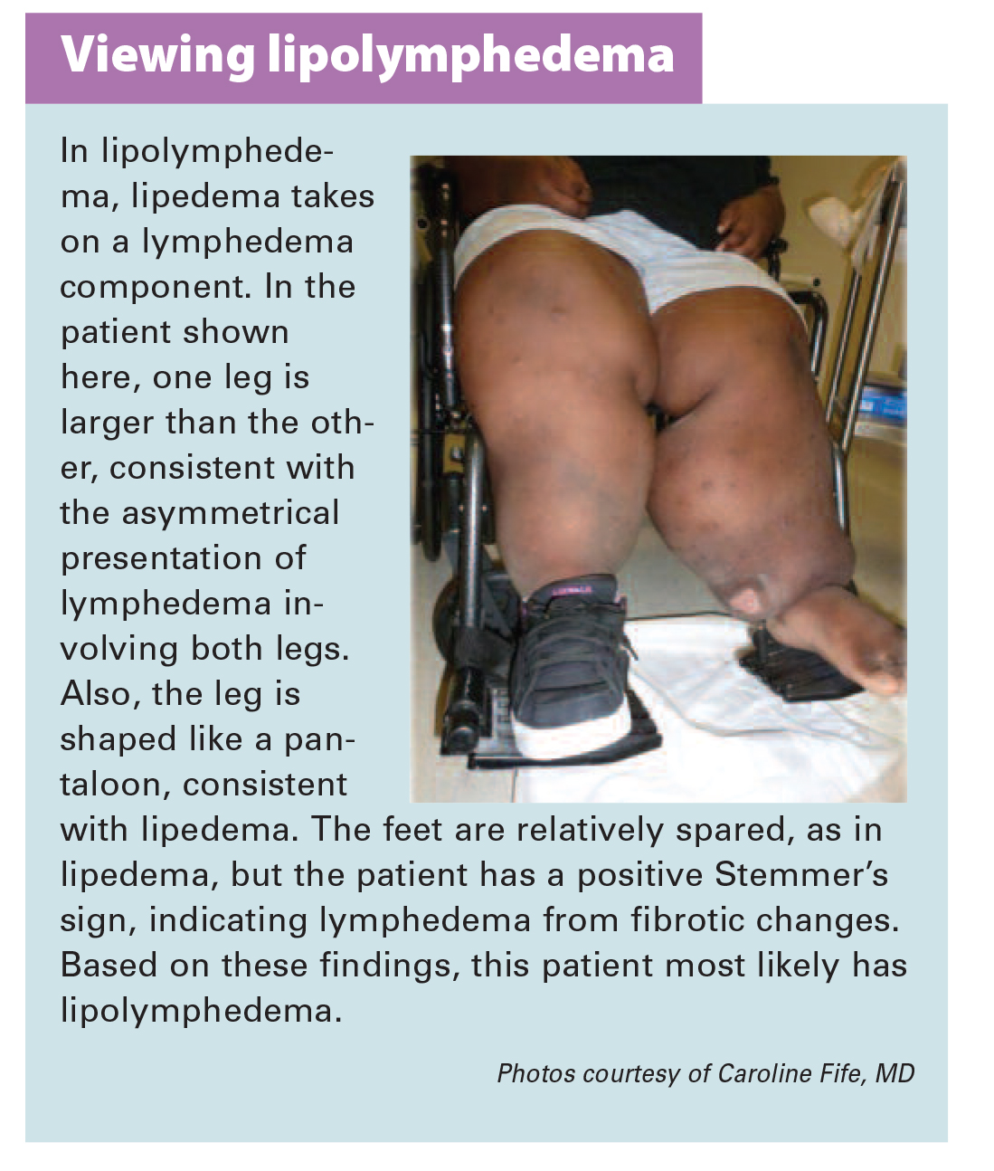 Lipedema Can Cause Disfiguring Fat Deposits In Women : Shots