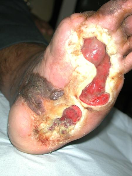 Diabetic Foot Ulcers