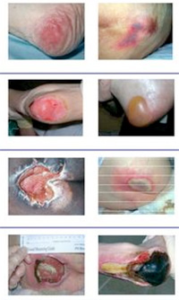 Wound exudate types