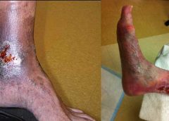 Managing chronic venous leg ulcers — what’s the latest evidence?