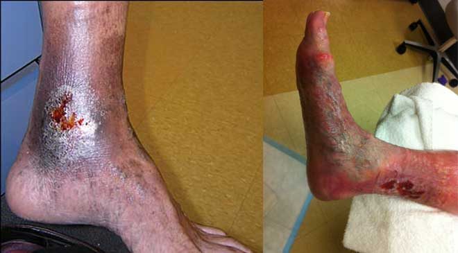 Managing chronic venous leg ulcers — what’s the latest evidence?