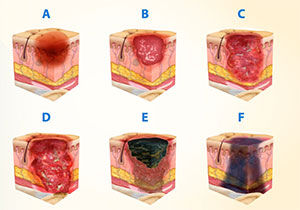 Pressure Injury Staging