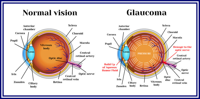 Glaucoma