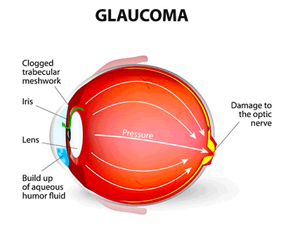 Glaucoma