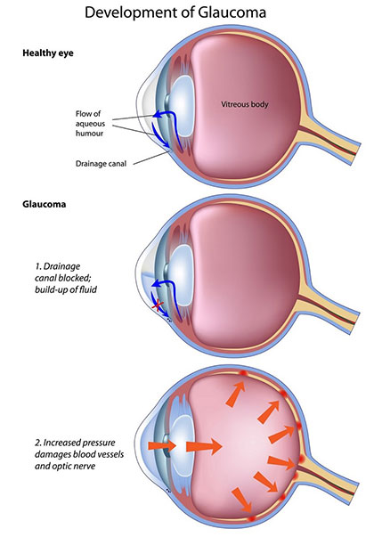 development of glaucoma