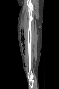 thigh fluid gas ct scan