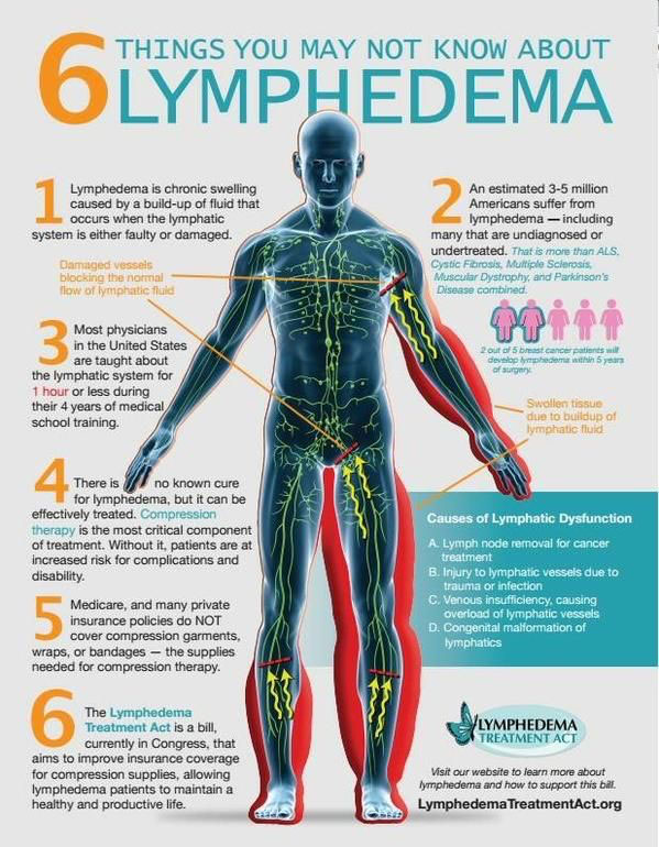 Helping Patients with Lymphedema