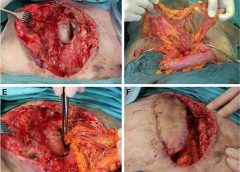 omentum flap procedure deep sternal wound infection wca