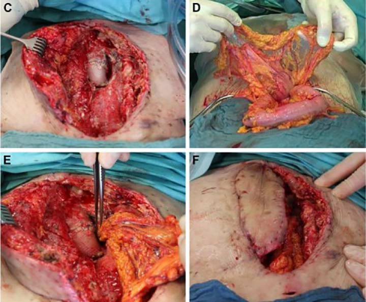 omentum flap procedure deep sternal wound infection wca