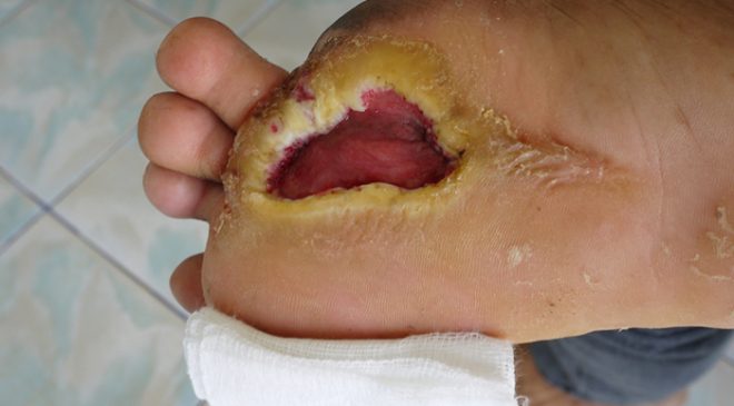 Diabetic foot ulcers heal faster with probiotic supplementation