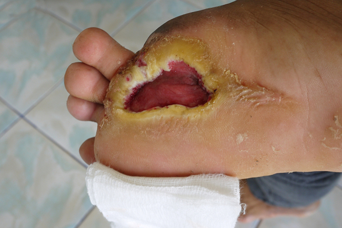 Healing sales foot ulcer